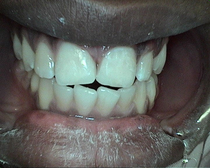 composite fillings after