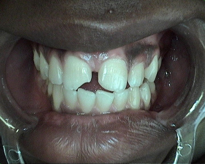 composite fillings before