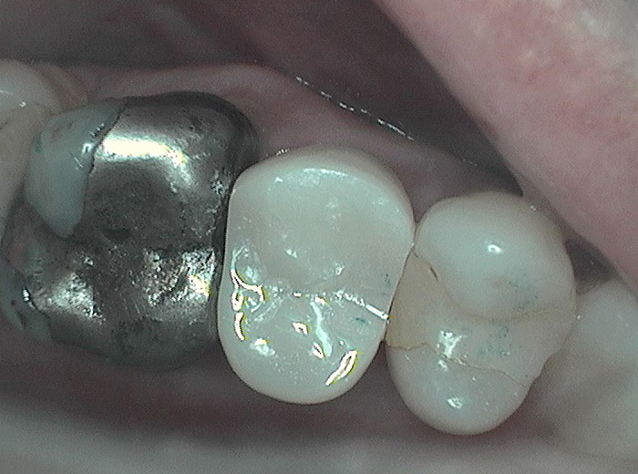 composite fillings before