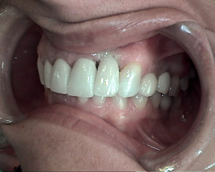 implant after