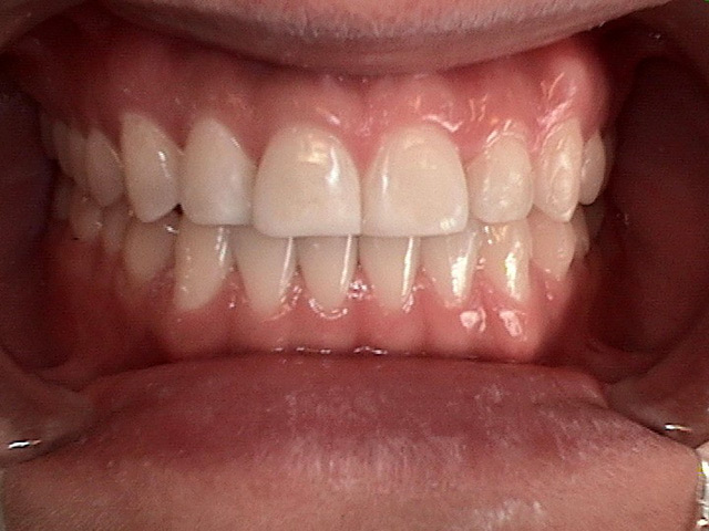 composite fillings after
