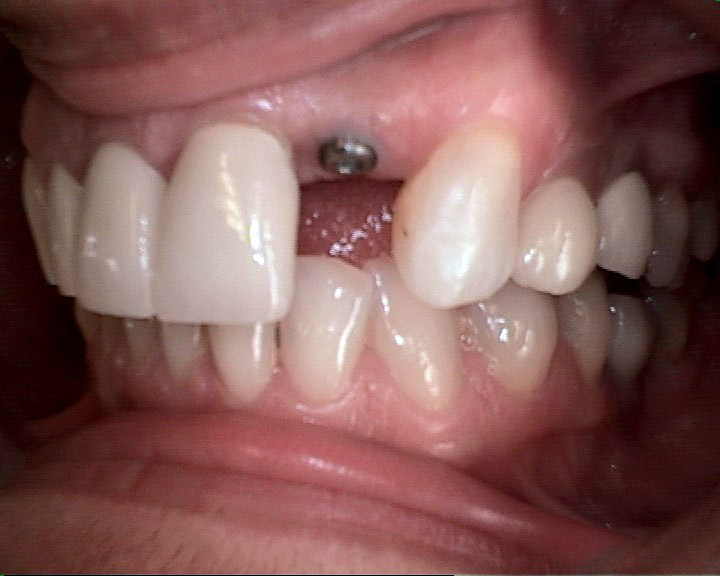 implant before